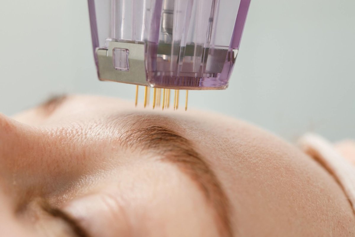 What Does Microneedling Do For Your Skin
