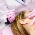 PDO Threads procedure in Salem, NH targeting eye-area wrinkles.