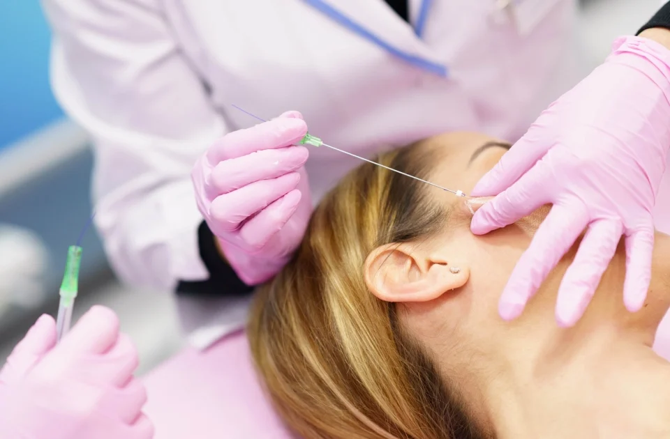 PDO Threads procedure in Salem, NH targeting eye-area wrinkles.