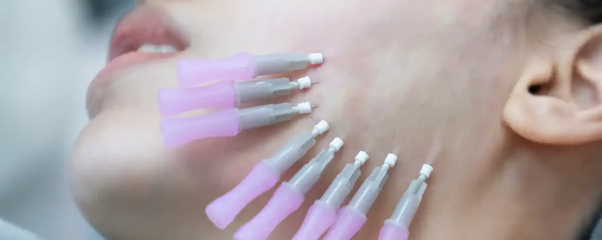 PDO Thread Lifts in Salem, NH