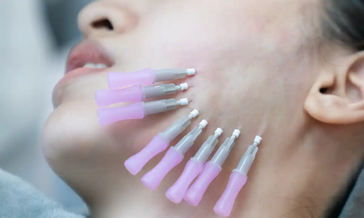 PDO Thread Lifts: Complete Guide Before Treatment