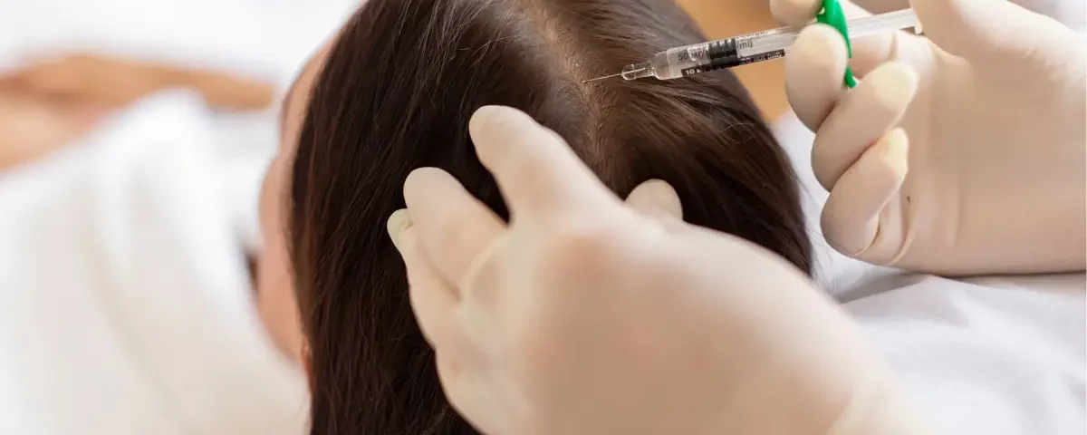 A professional aesthetic treatment session for hair restoration using natural growth factor injections in Salem, NH