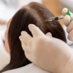 A professional aesthetic treatment session for hair restoration using natural growth factor injections in Salem, NH