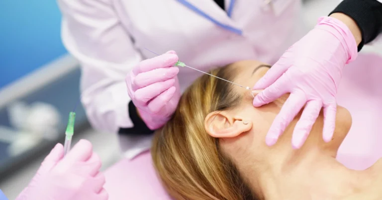 PDO Threads procedure in Salem, NH targeting eye-area wrinkles.