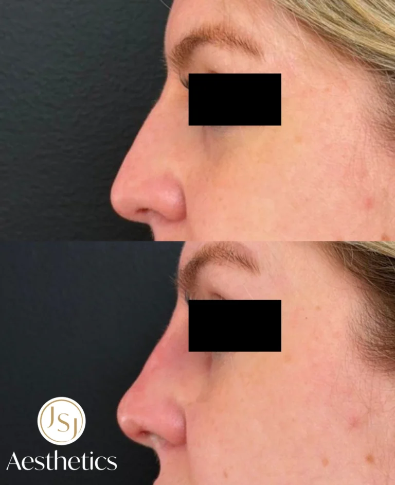 Before After Full Face PDO MAX Thread Lift jsjaesthetics c